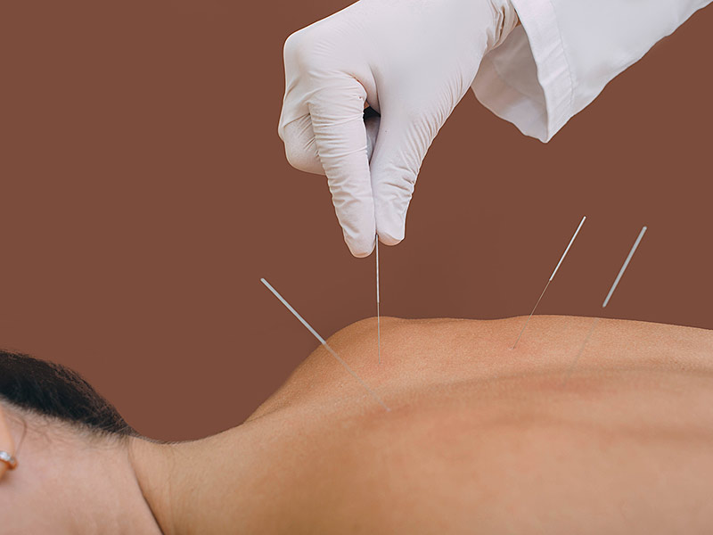 Acupuncture Treatments - Balance Acupuncture